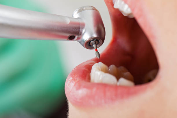 Best Emergency Dental Care for Broken or Chipped Teeth in South Bend, WA